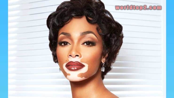 Winnie Harlow Biography